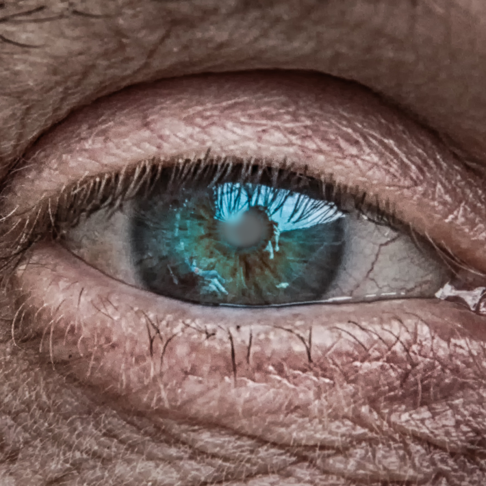 Cataracts