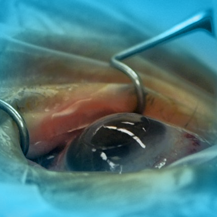 Corneal Transplant