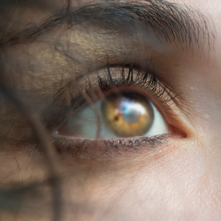 Glaucoma