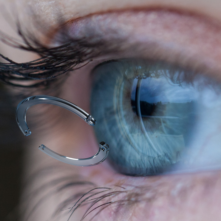 Keratoconus